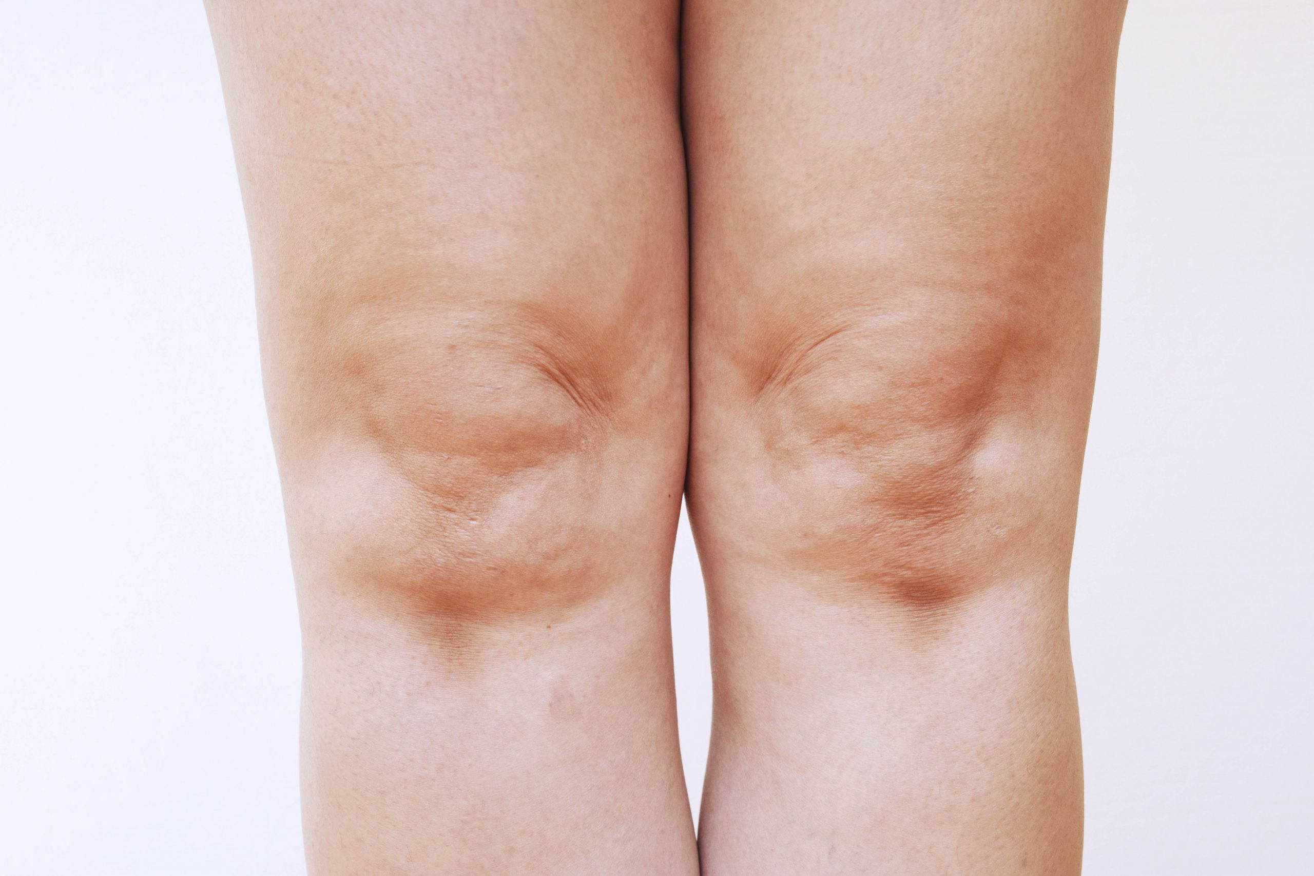 記事 「膝が痛い」予防のアイキャッチ画像