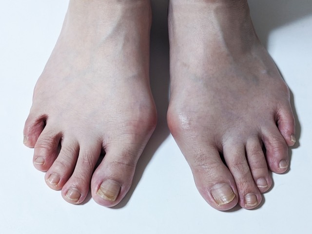 記事 外反母趾の予防方法を知っていますか？のアイキャッチ画像